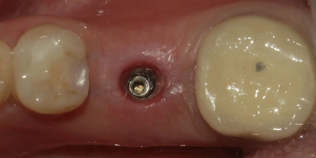 implant dentar i sheruar