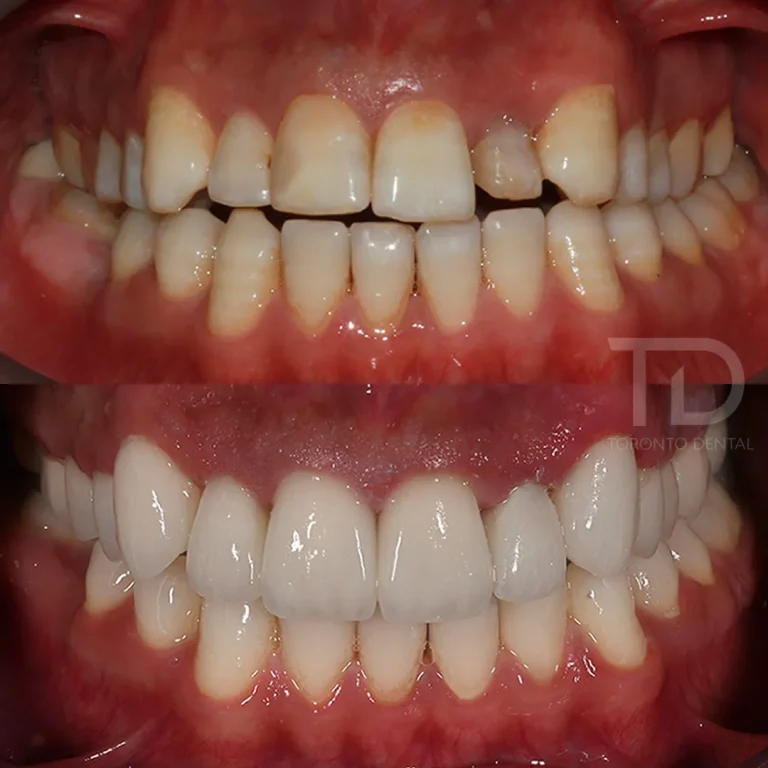 before and after dental veneers iin albania