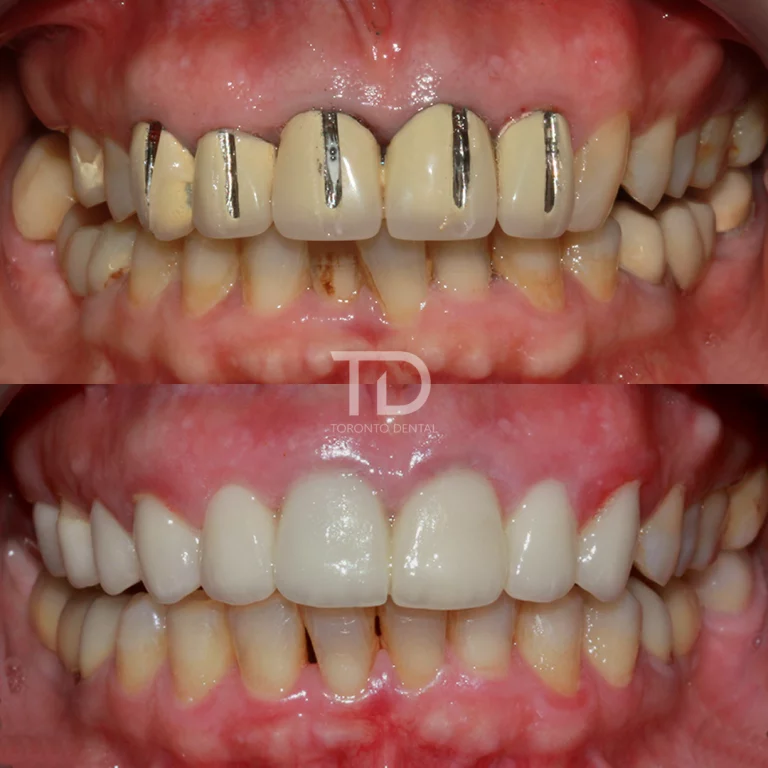 before and after dental crowns