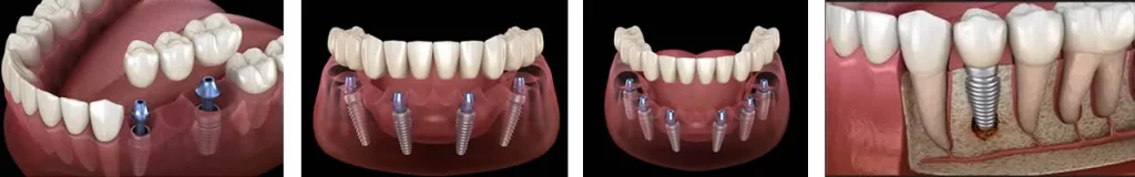 all types of dental implant treatments in one image